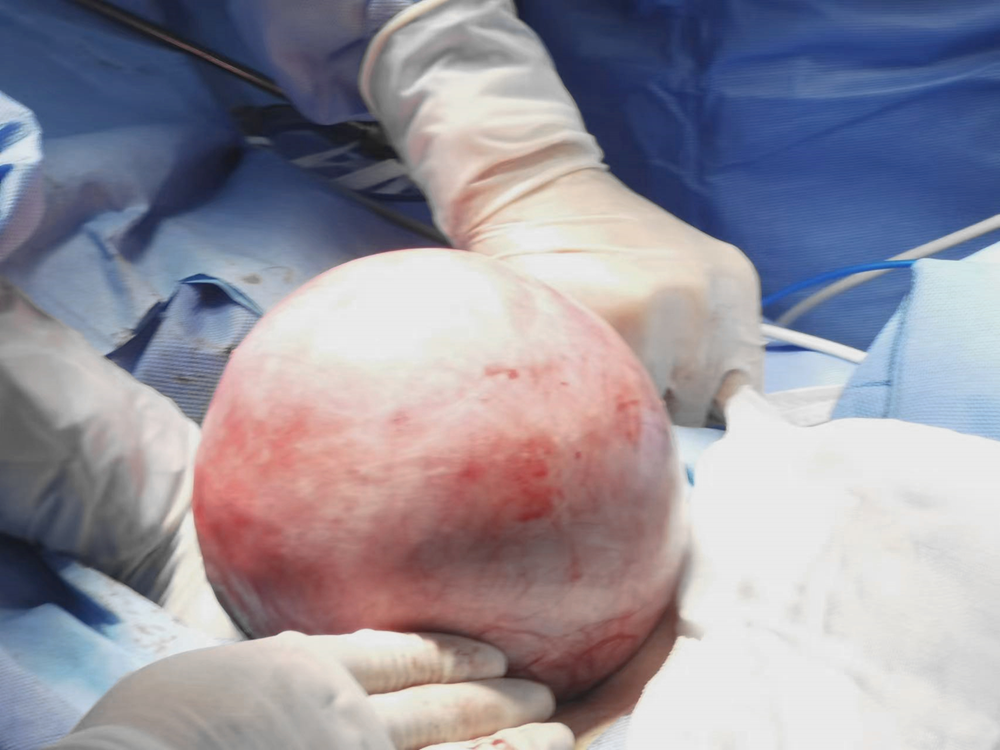 办实事 | 没想到 一次检查竟意外发现&ldquo;胎儿头&rdquo;大小罕见肿瘤